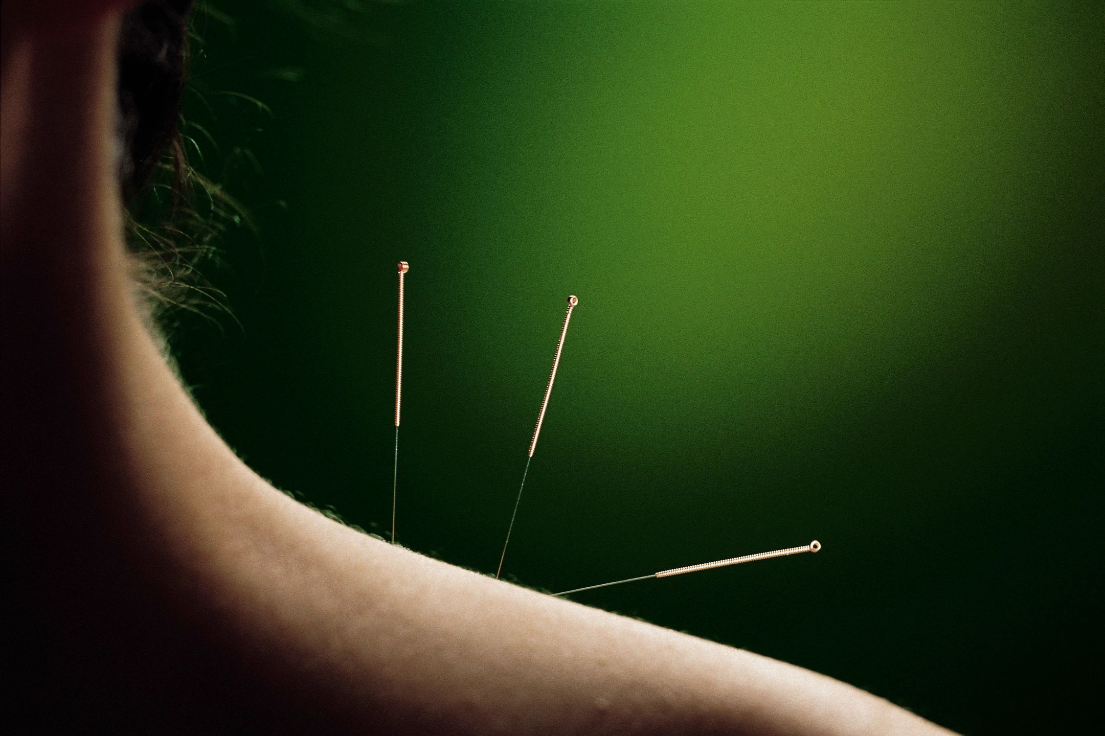 Is Acupuncture Safe? What You Need to Know