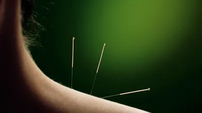 Is Acupuncture Safe? What You Need to Know