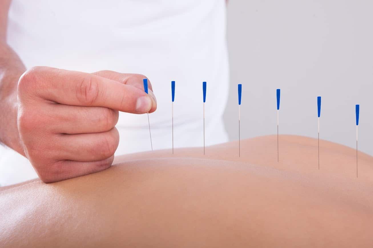 4 Commonly Asked Questions About Acupuncture