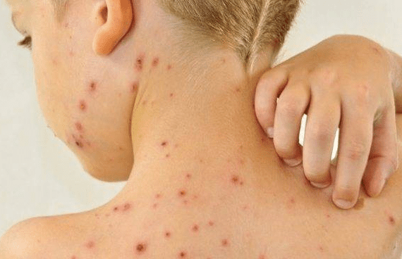 Três Lagoas inicia vacinação de dose zero contra sarampo