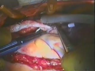 Coronary Anastomosis — OM1