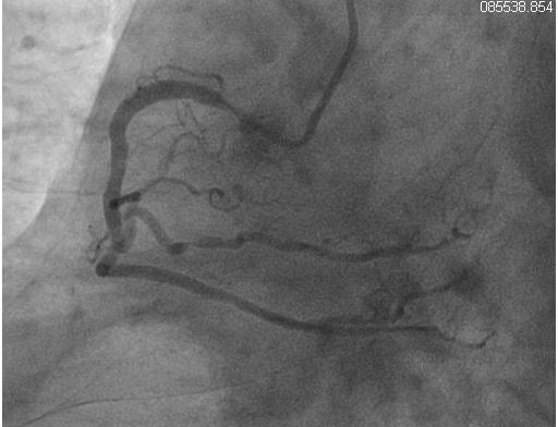 Diffuse Coronary Disease