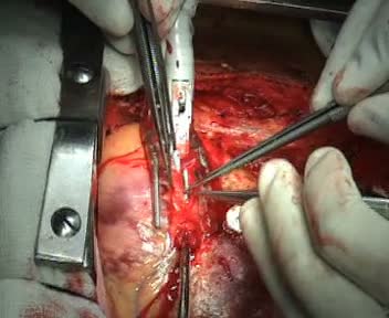 Beating-Heart Bypass — The Film