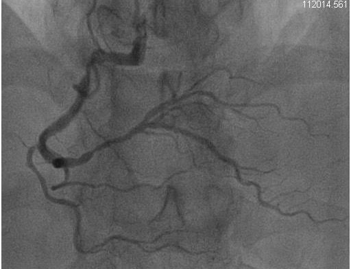 Critical RCA Stenosis