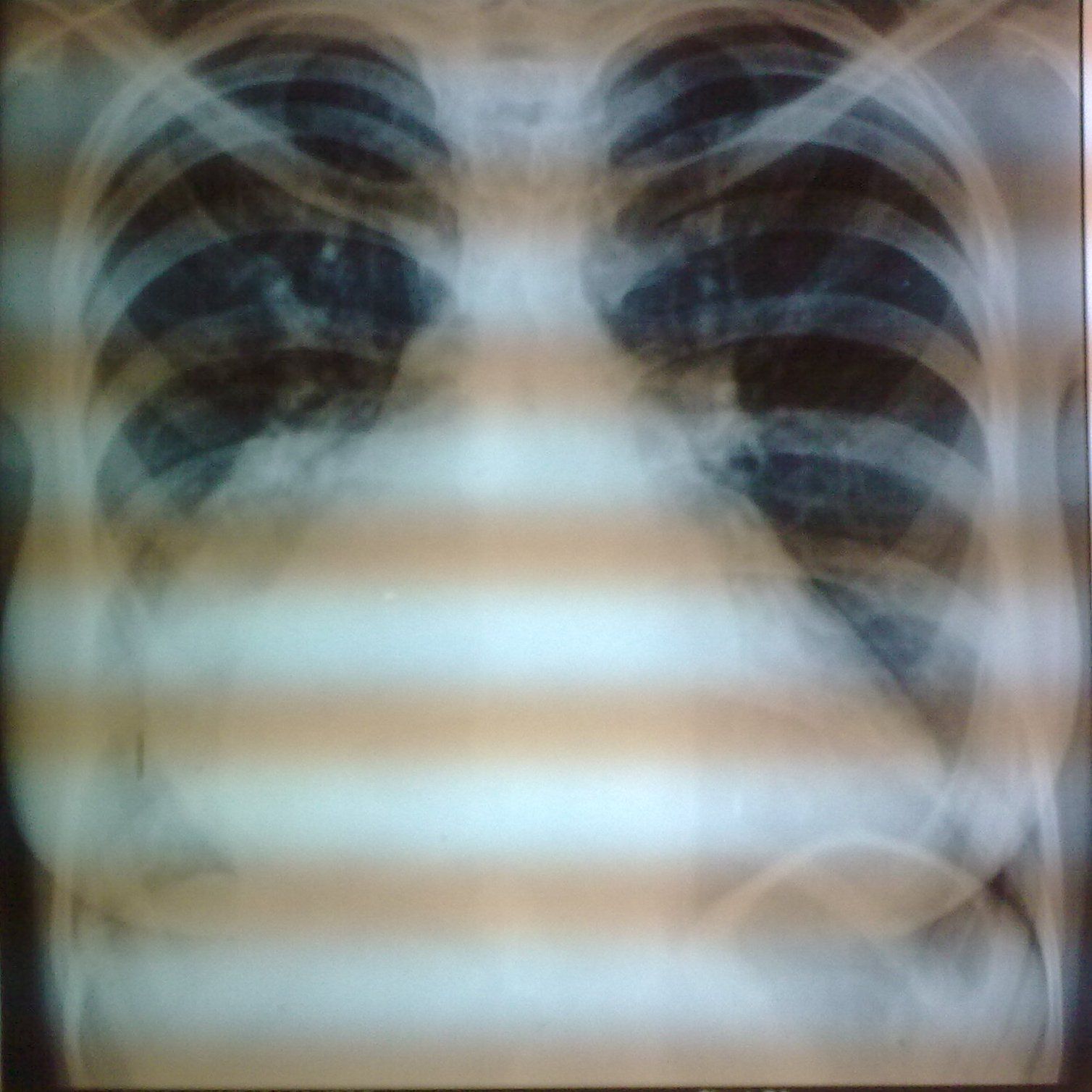 Valvular Heart Disease