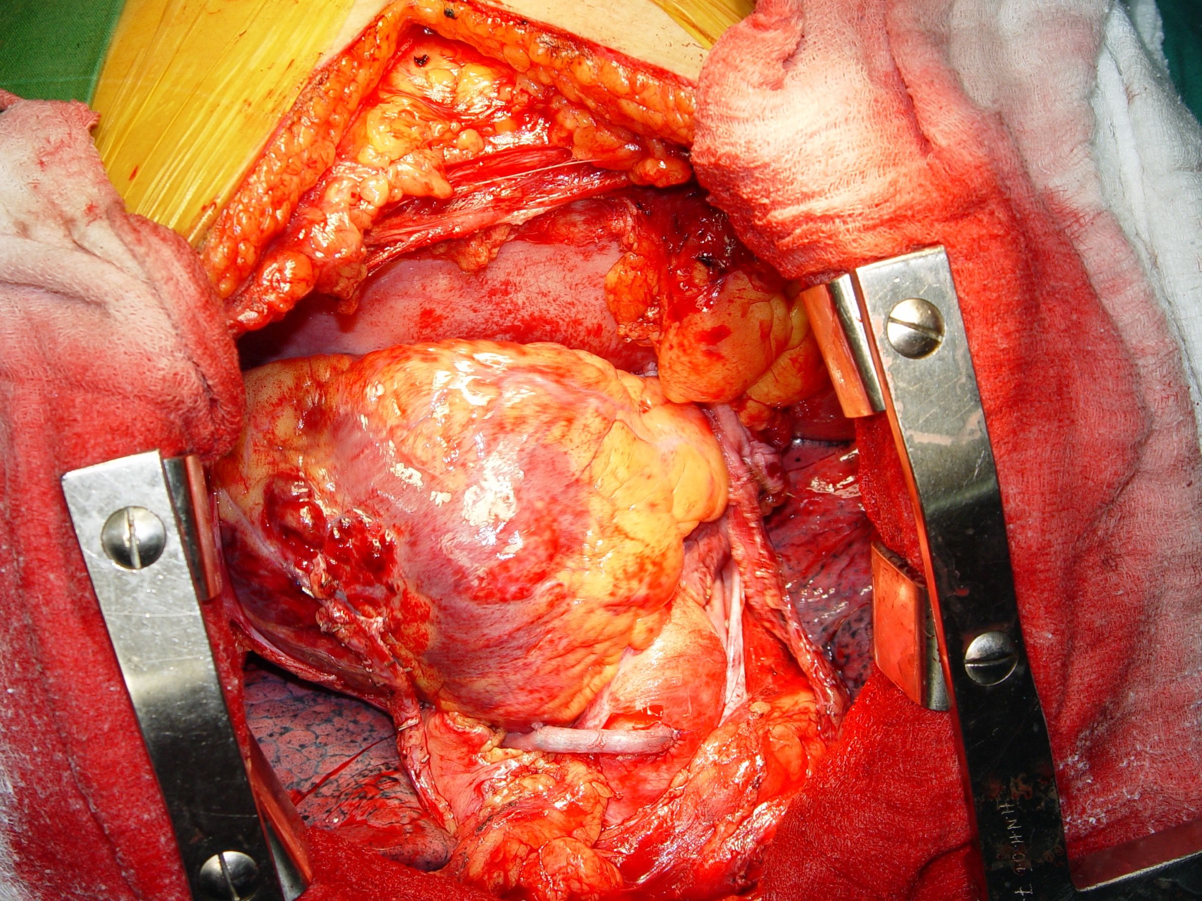 Bilateral IMA Grafts