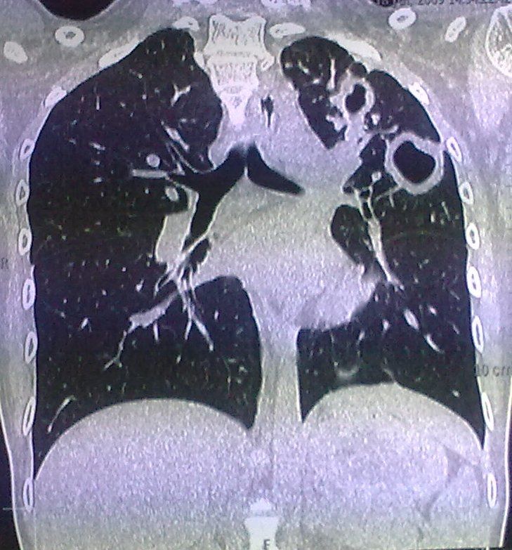 Tuberculous Cavities