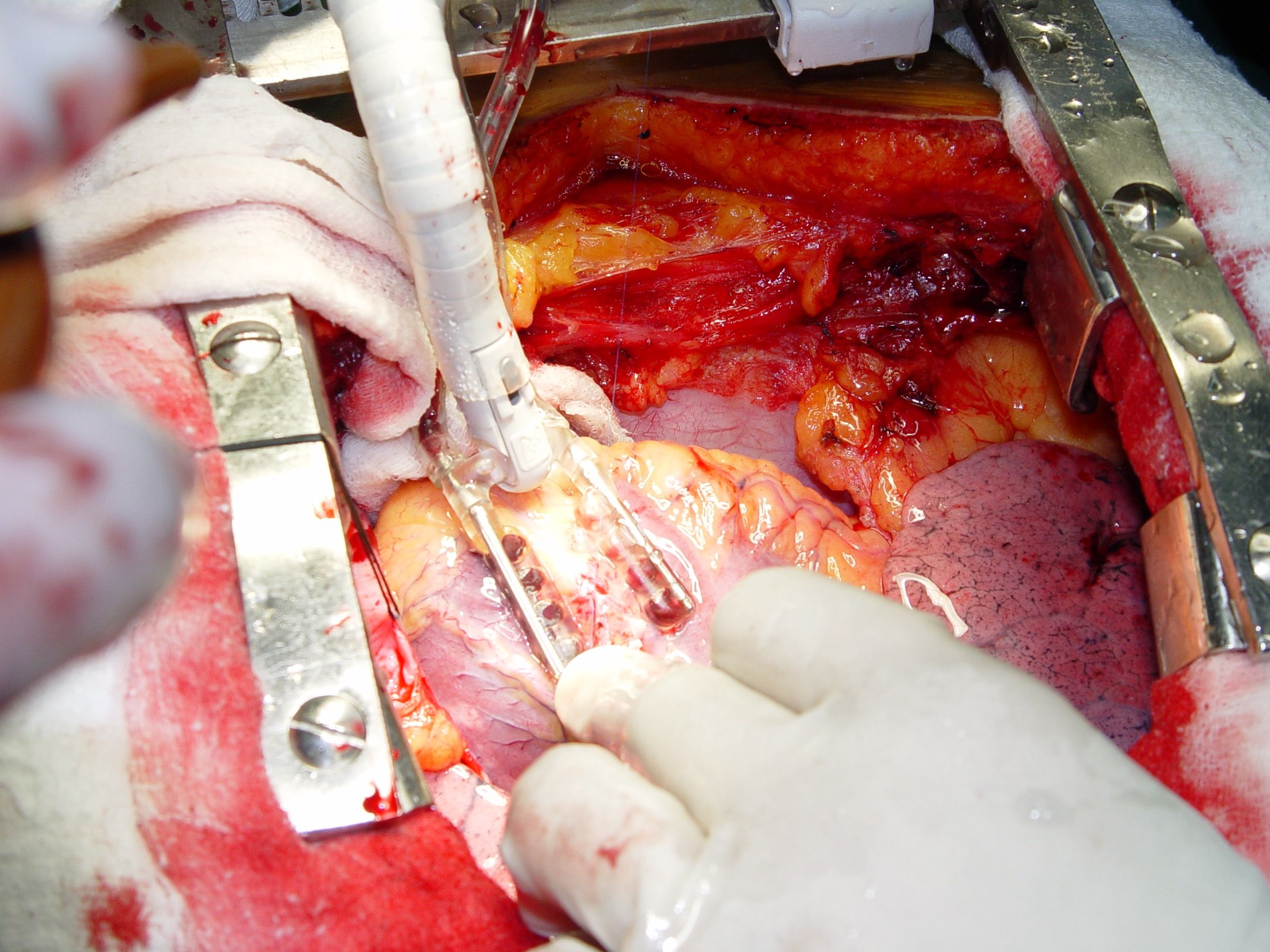 Beating Heart Surgery