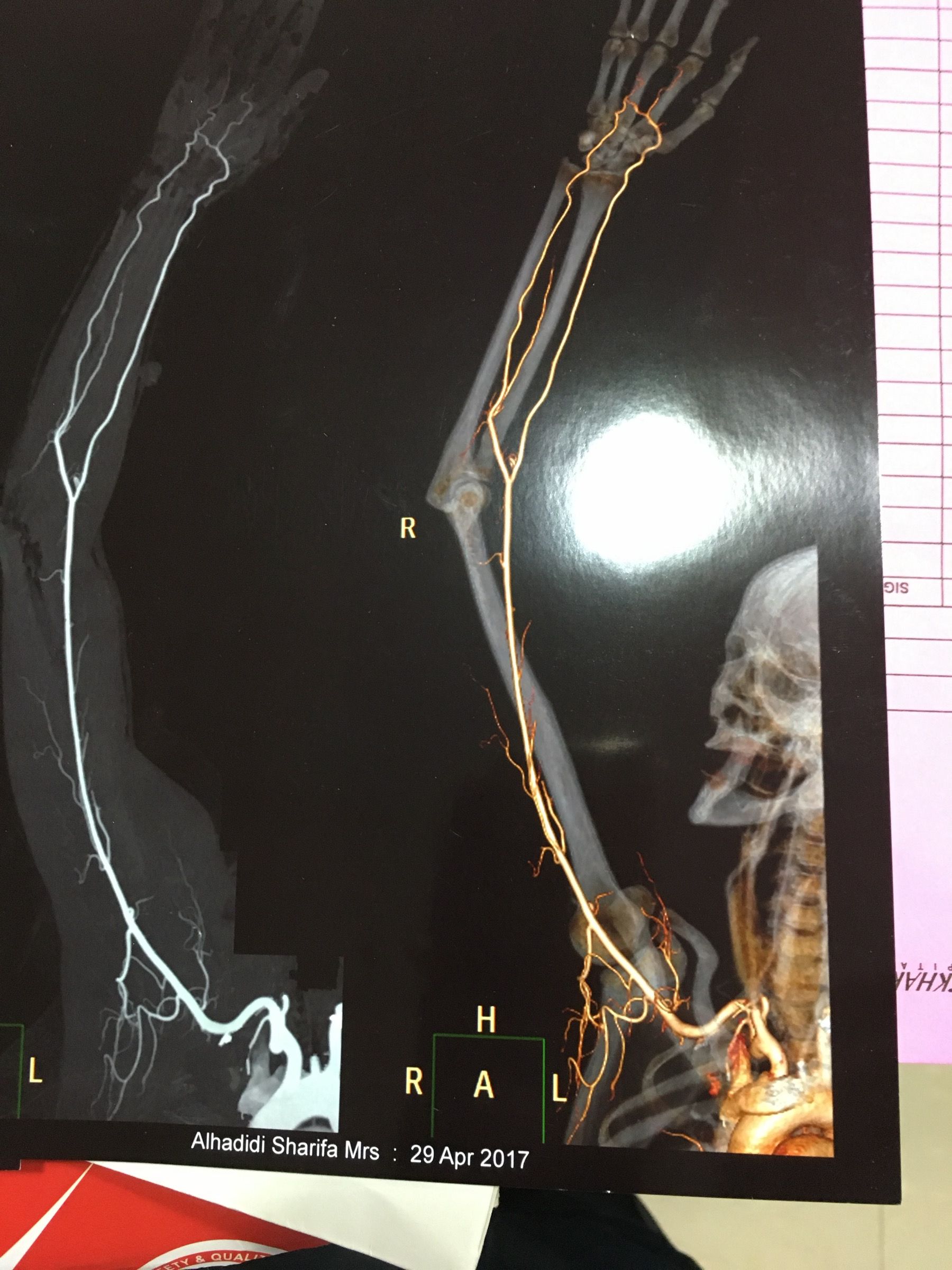 3D Vascular Mapping
