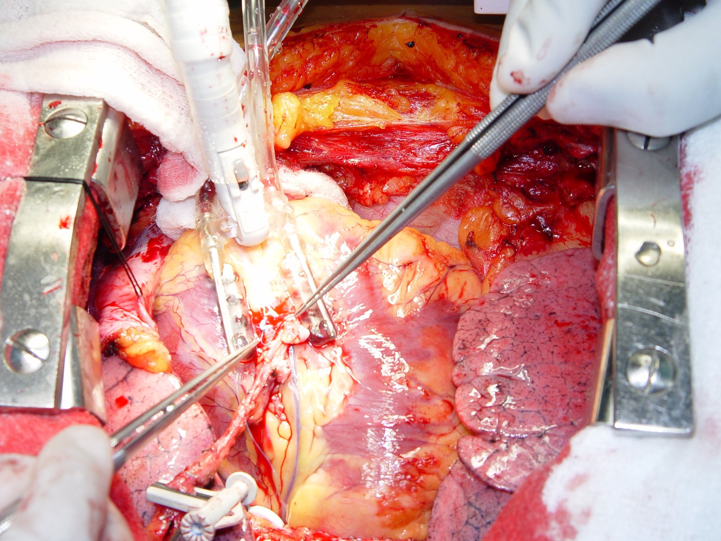 Beating Heart CABG