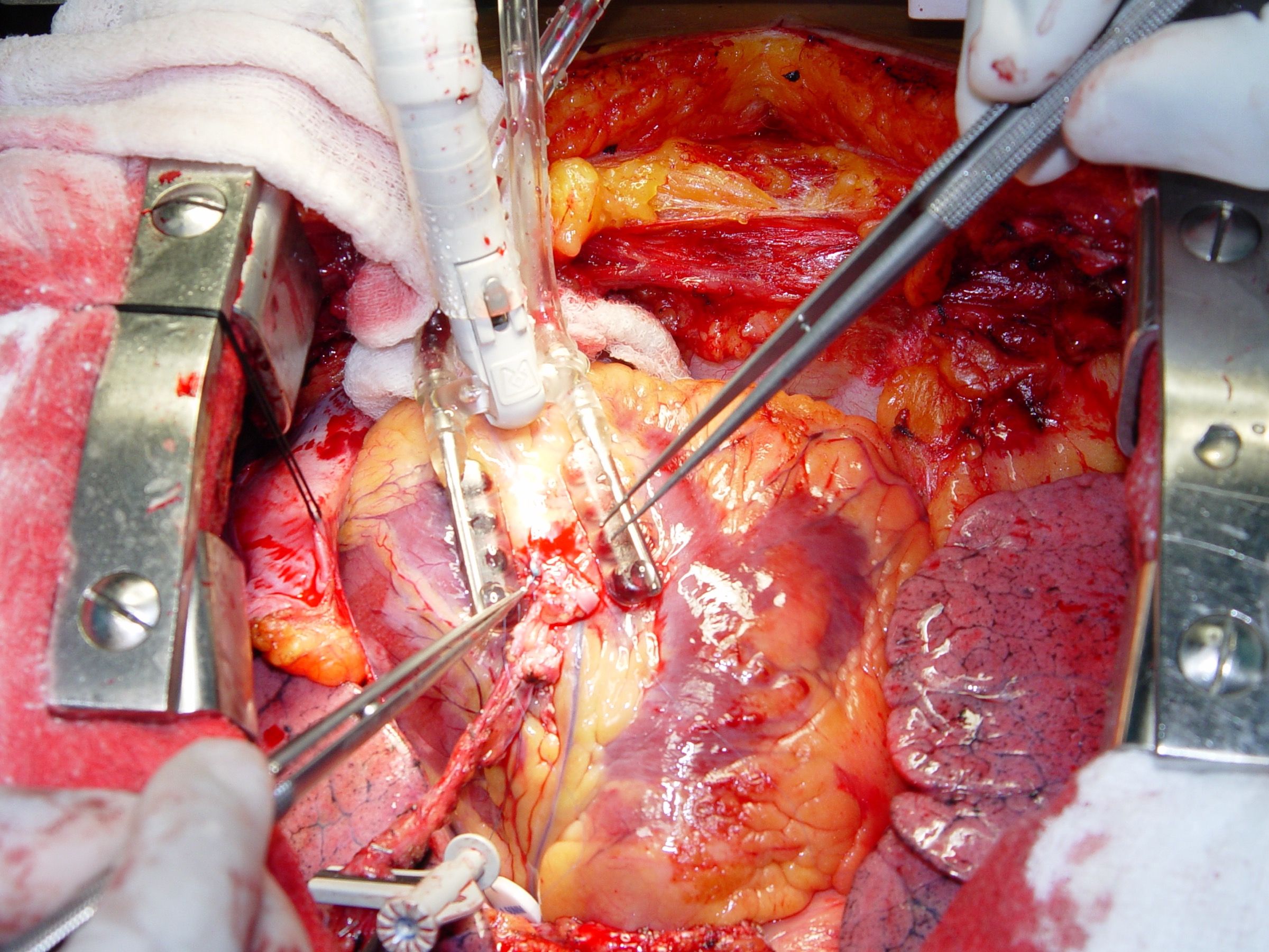 LIMA to LAD Anastomosis