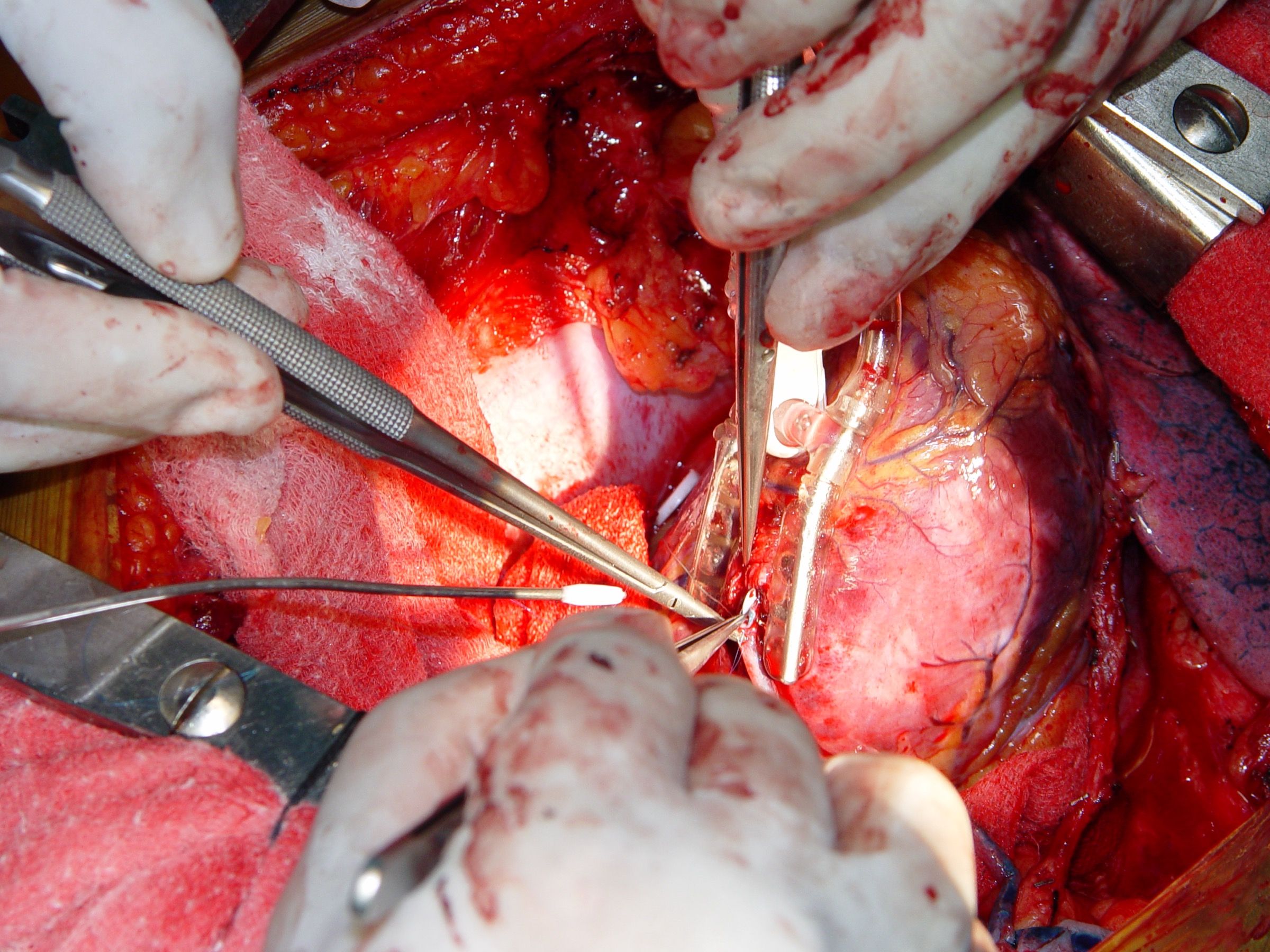 Coronary Anastomosis