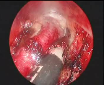 Endoscopic Vessel Harvesting