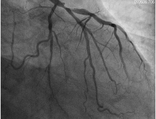 Severe Triple-Vessel Disease