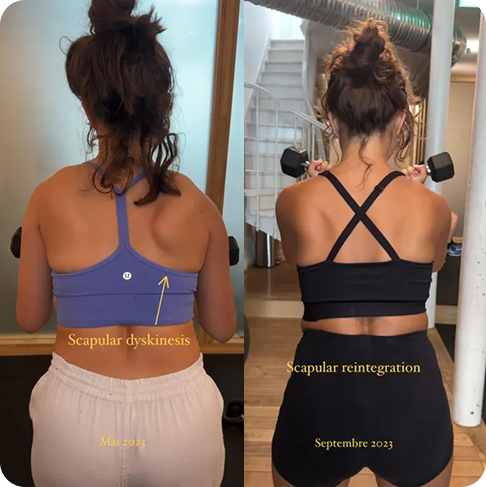 SCAPULAR REINTEGRATION