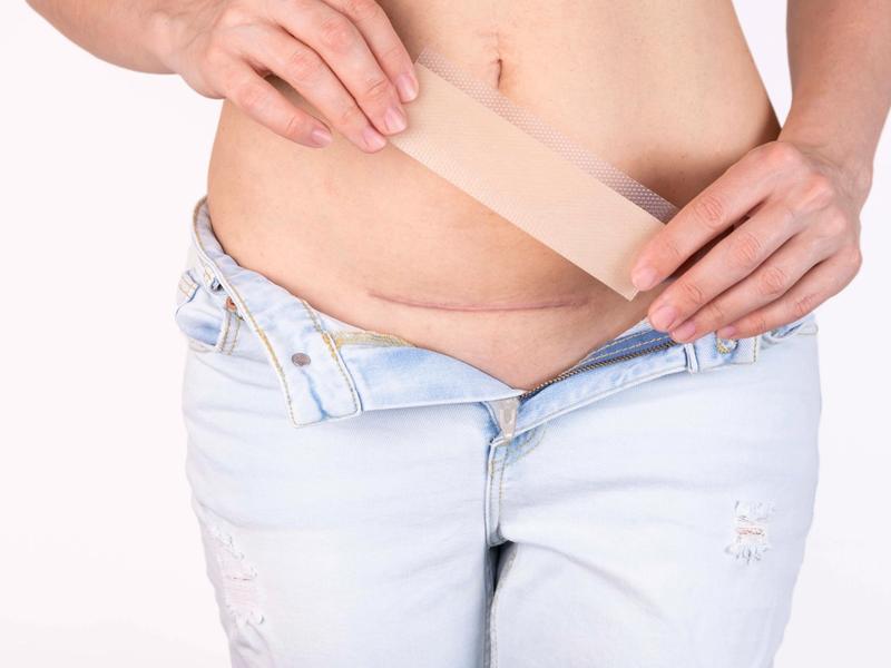 C-Section recovery: a practical guide to healing, scar care, and pain management