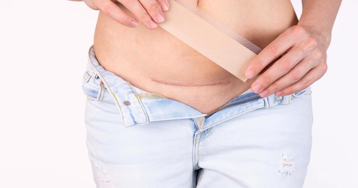 C-Section recovery: a practical guide to healing, scar care, and pain management