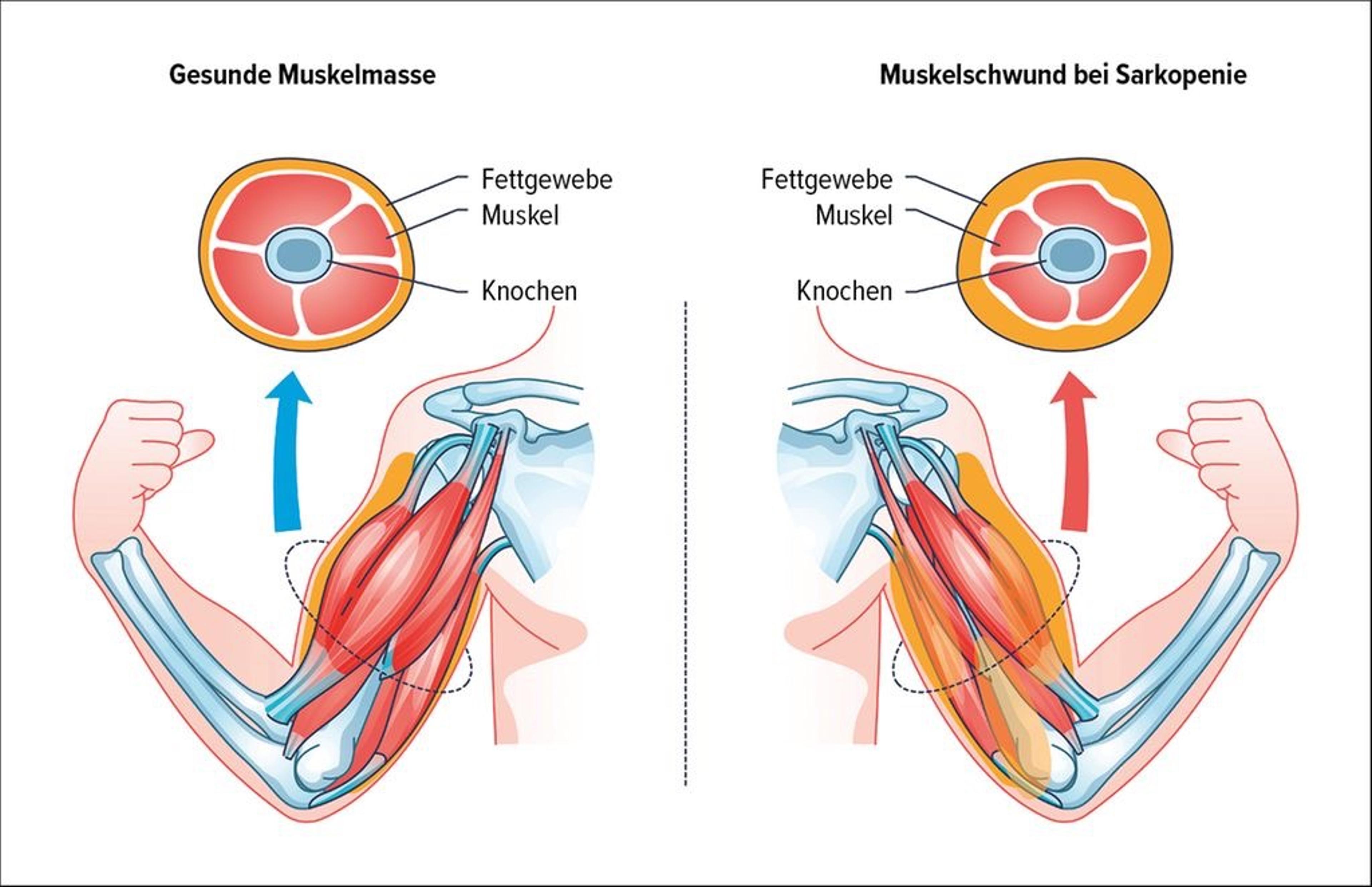 Illustration zeigt den Unterschied zwischen gesunder Muskelmasse und Muskelschwund bei Sarkopenie