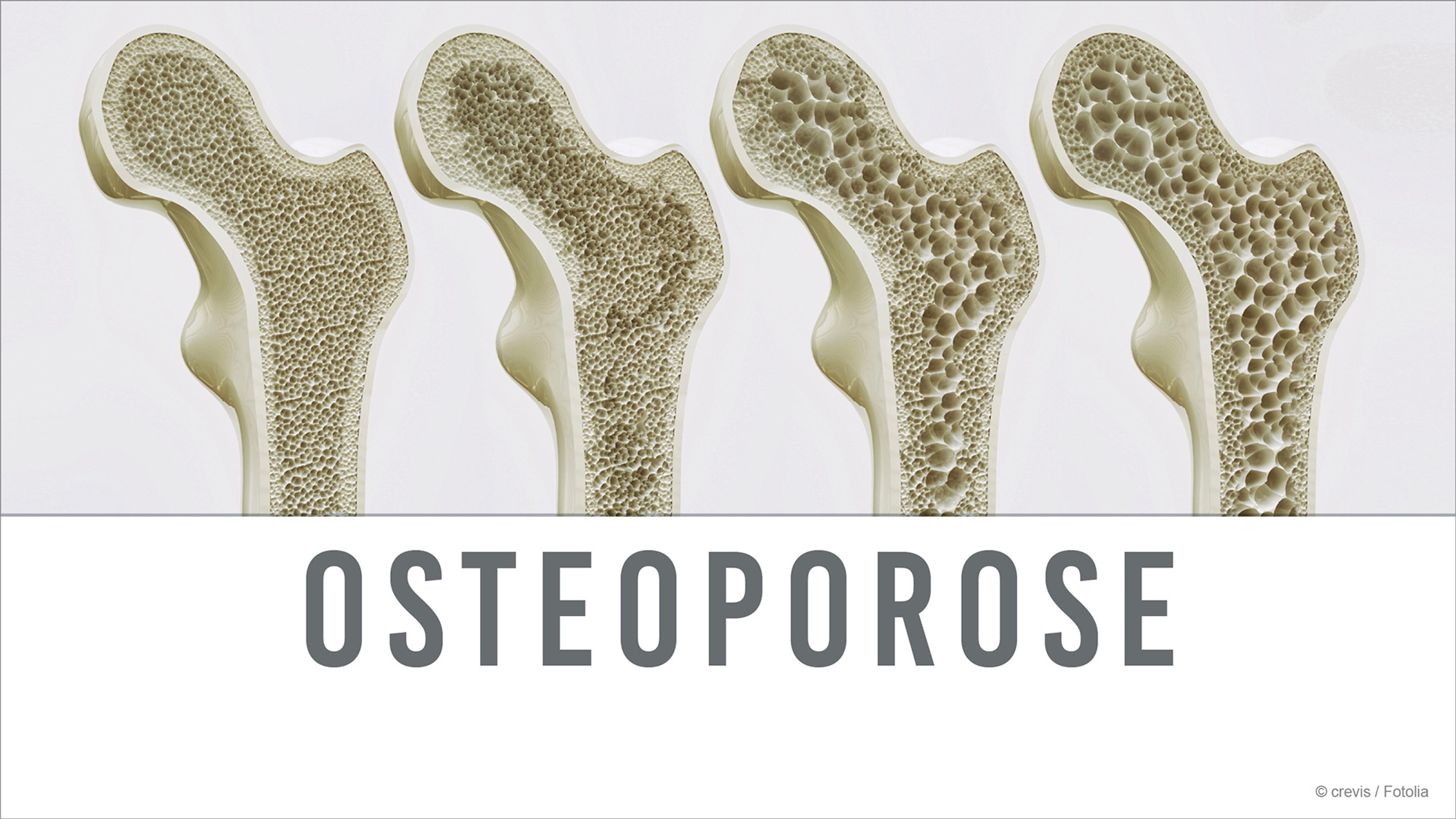 Illustration zeigt vier Stadien der Knochenstruktur bei Osteoporose