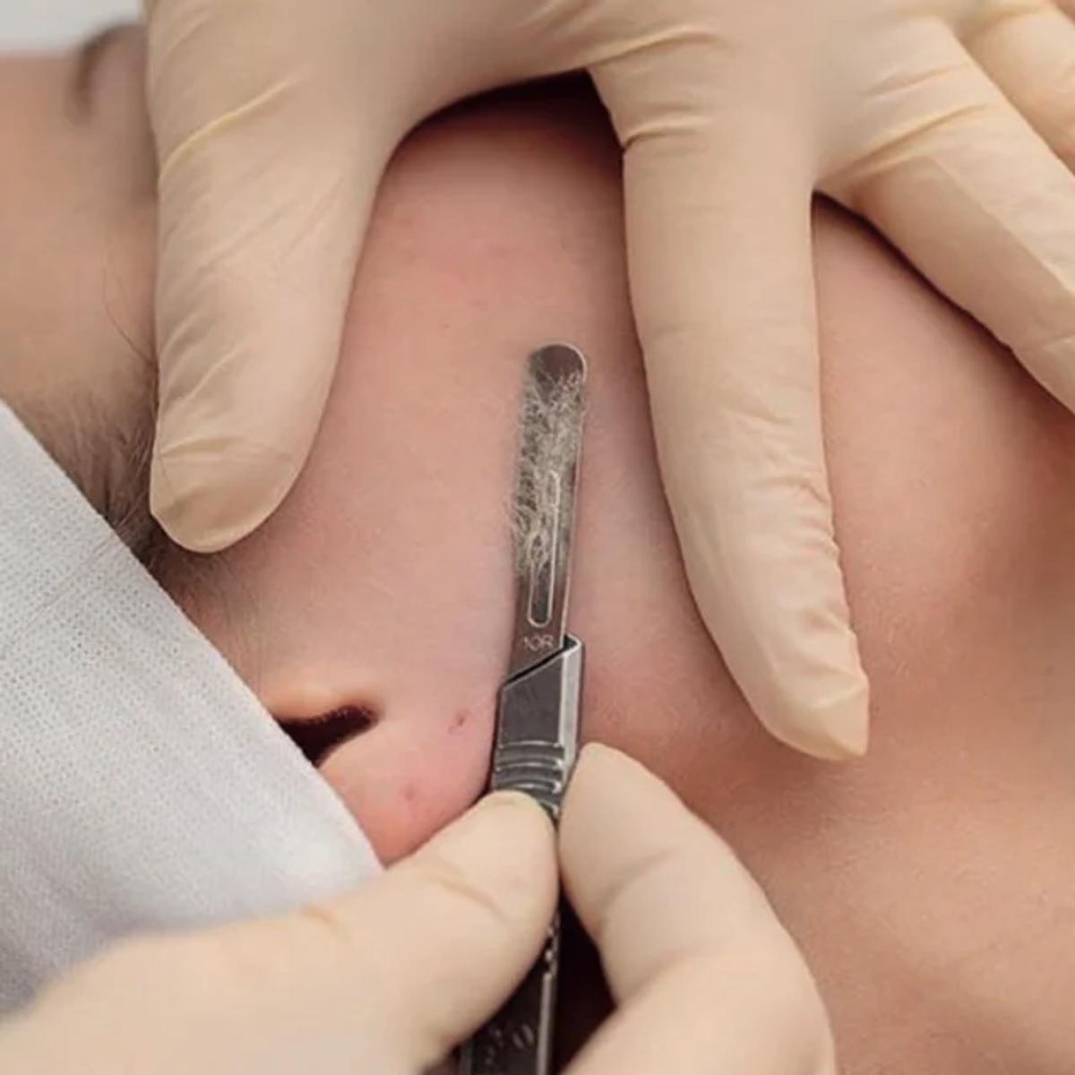 Dermaplaning