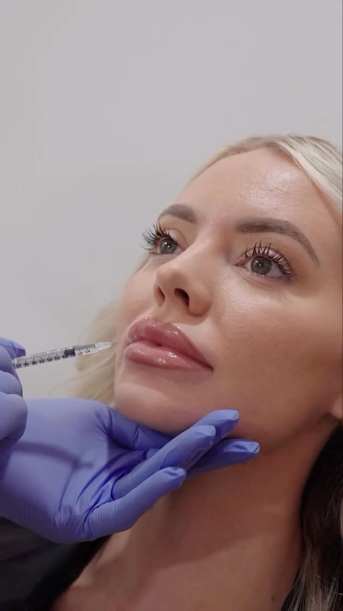 $150 OFF One Syringe of Lip Filler