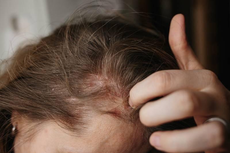 psoriasis-perte-de-cheveux