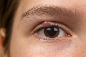 chalazion