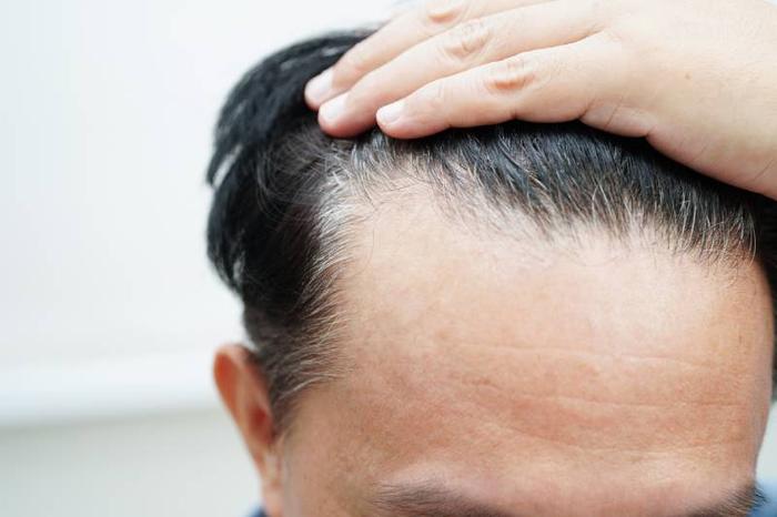 prix-greffe-de-cheveux