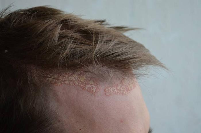 psoriasis