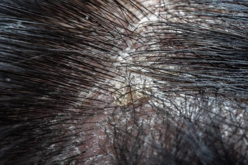 shampooing-psoriasis