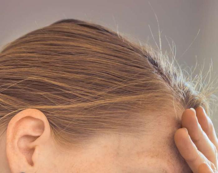 perte-de-cheveux-devant-du-crane-femme