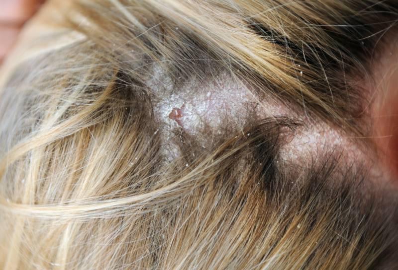 eczema-psoriasis