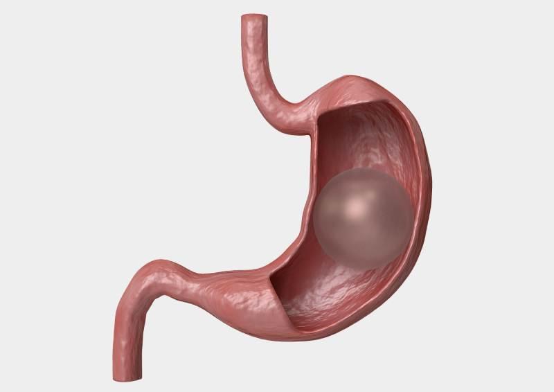qu-est-ce-qu-un-ballon-gastrique