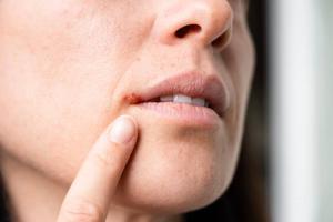 herpes-buccal