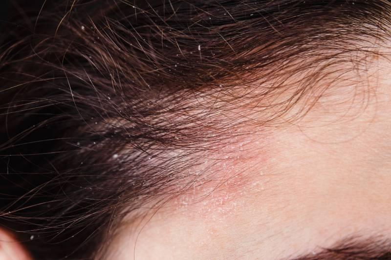 comment-soigner-le-psoriasis