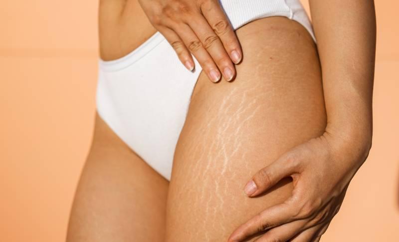 huile-de-massage-weleda-vergetures