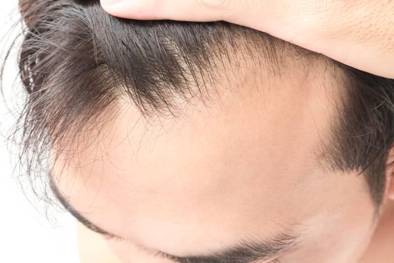 greffe-de-cheveux-france-prix
