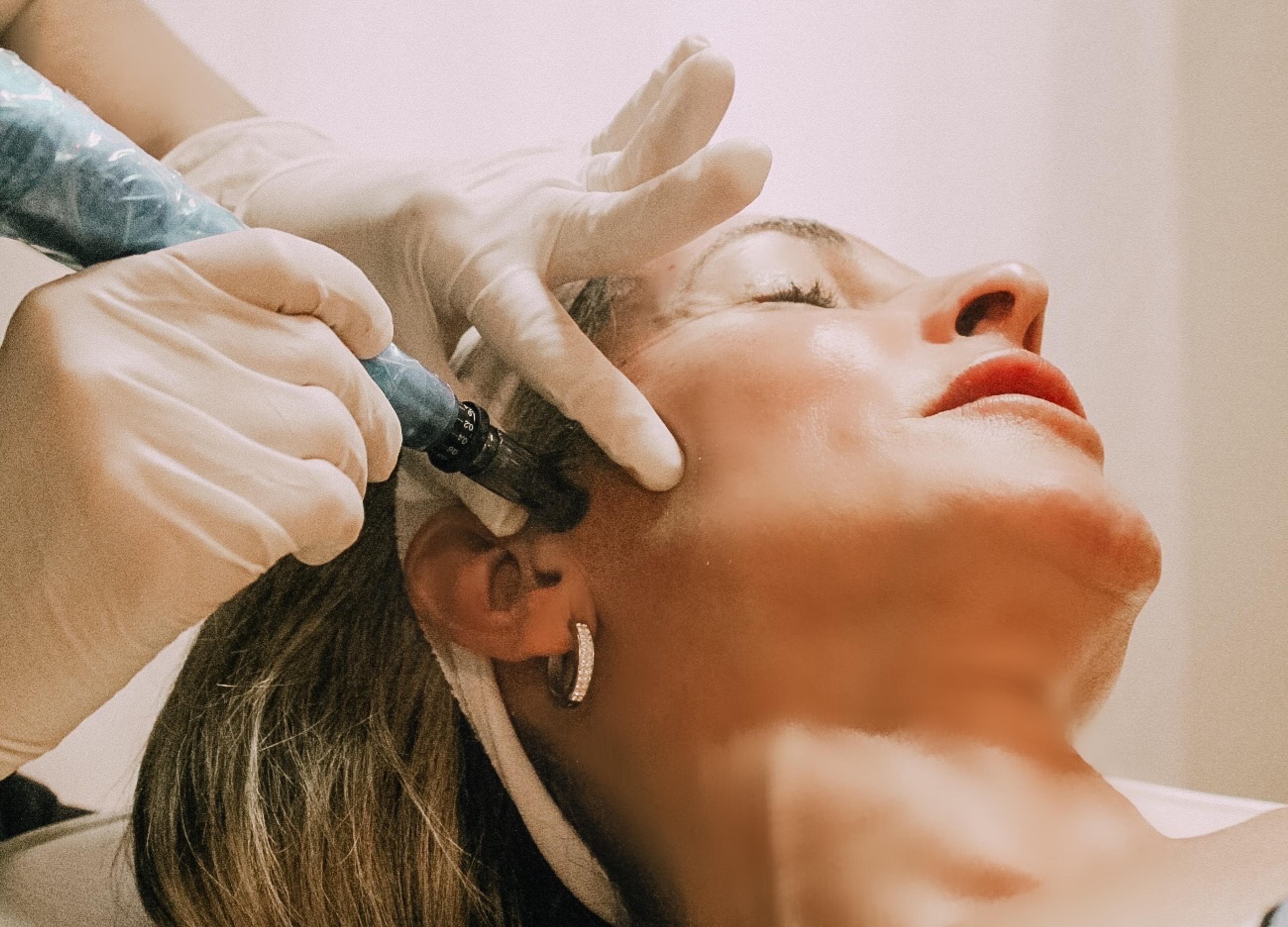 A microneedling treatment at RENU Medical Aesthetics
