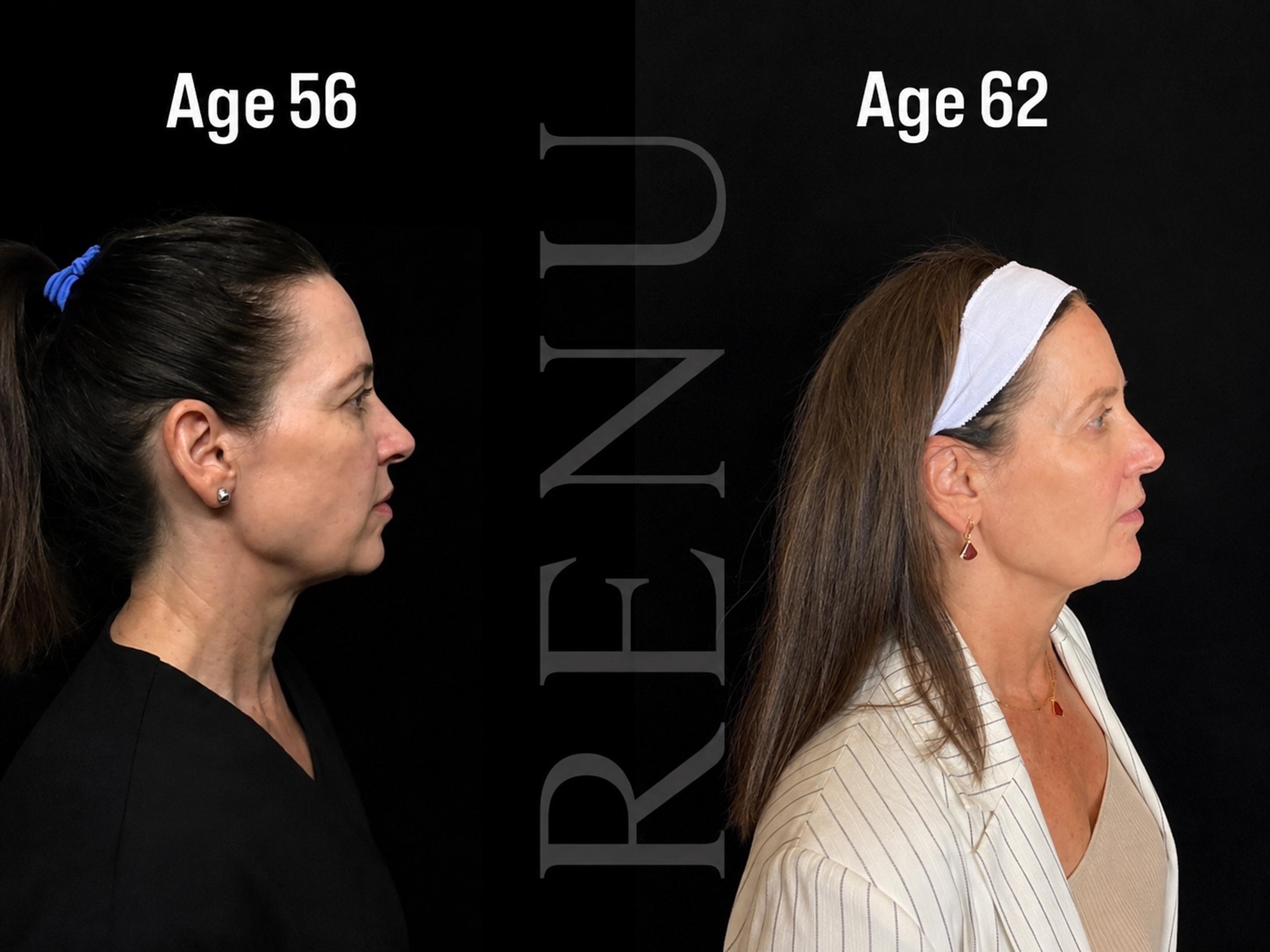 Patient before and after (Ages 56–62)