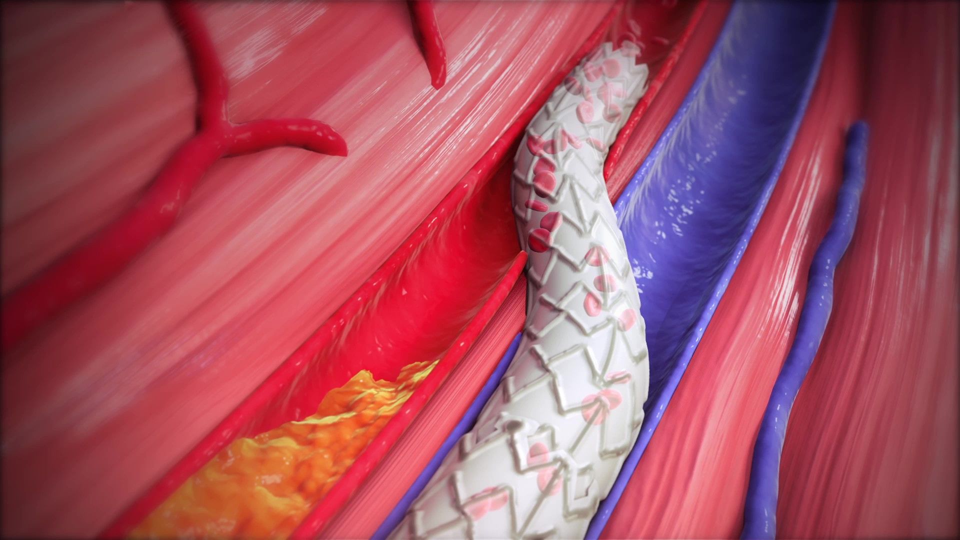 LimFlow PROMISE II trial shows 76% limb salvage in NEJM — Sofinnova ...