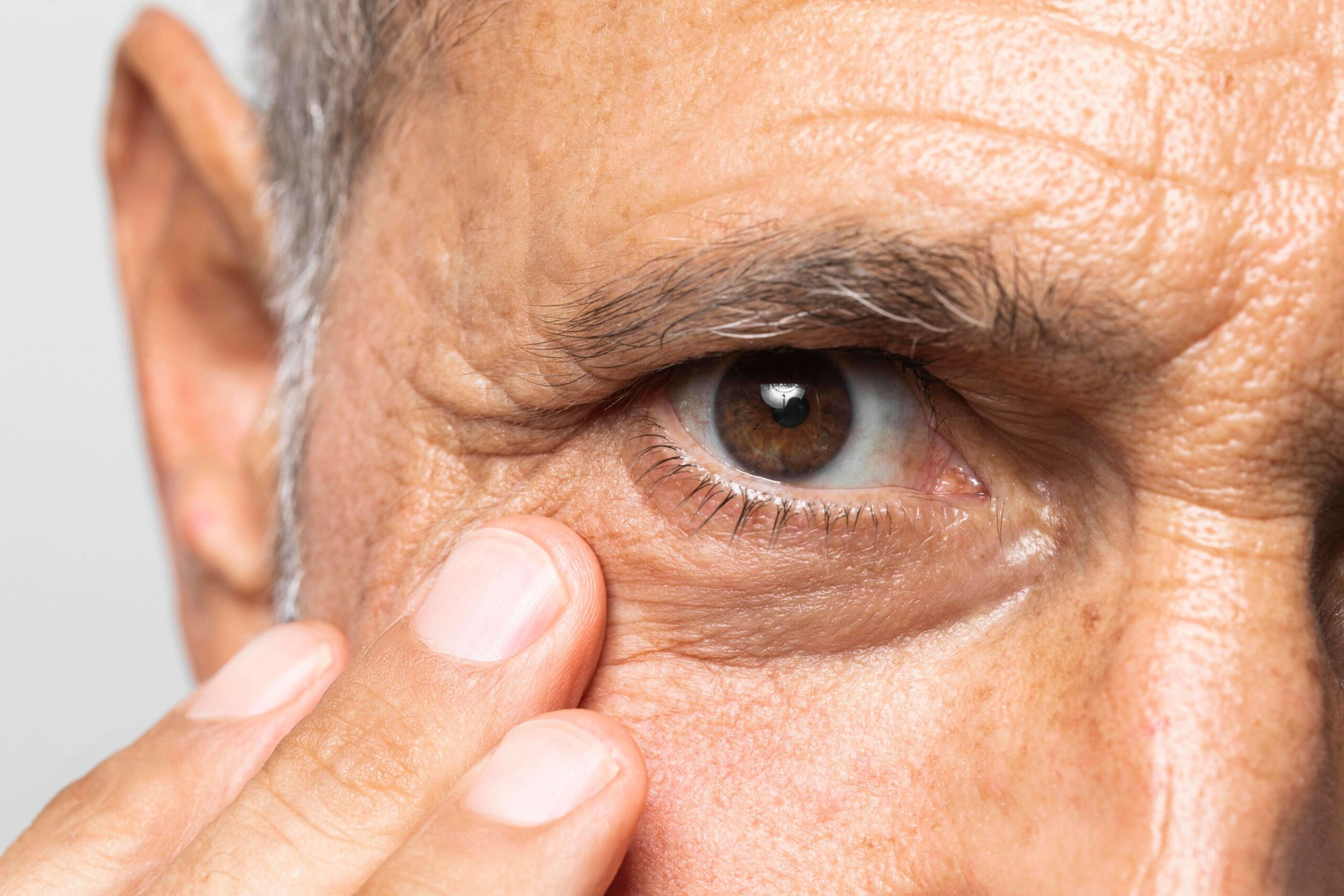 Degeneração macular relacionada à idade: O que é, sintomas e tratamento