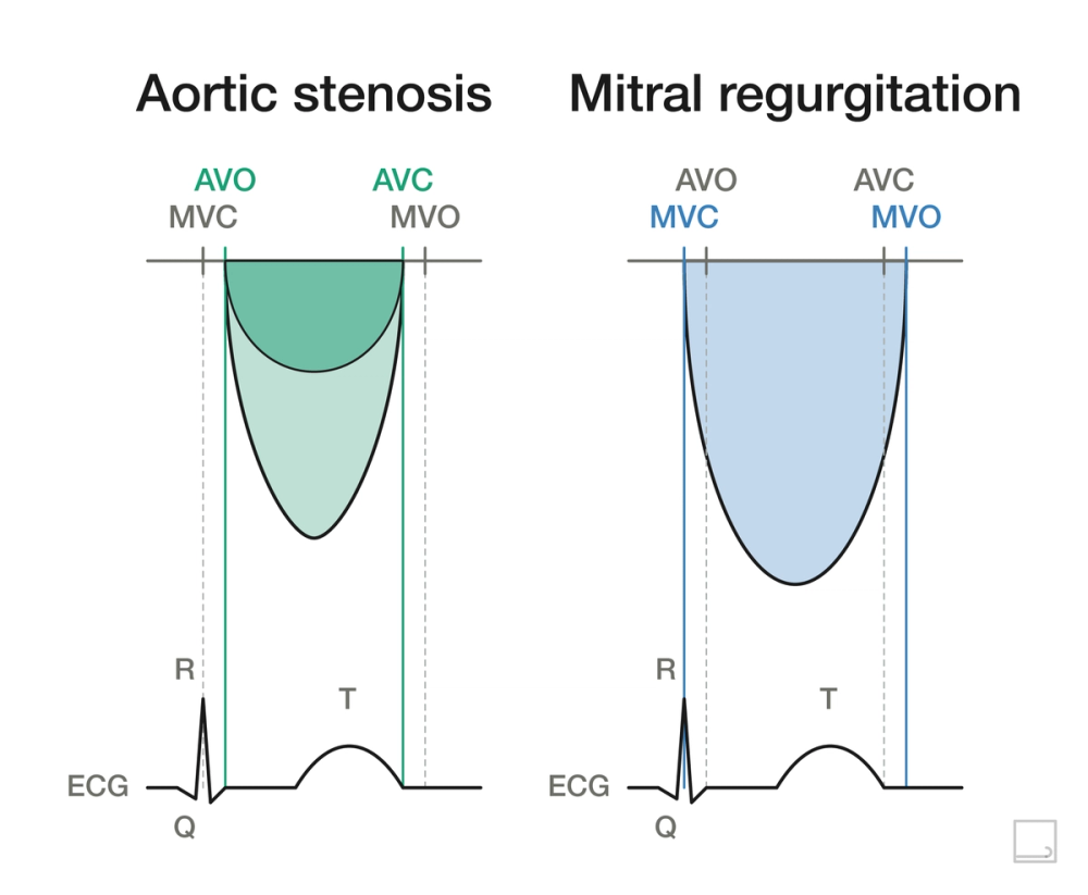 Continuous-wave Doppler traces of aortic stenosis and mitral regurgitation compared, with valve clicks (MVC, AVO, AVC, MVO) aligned to the ECG.