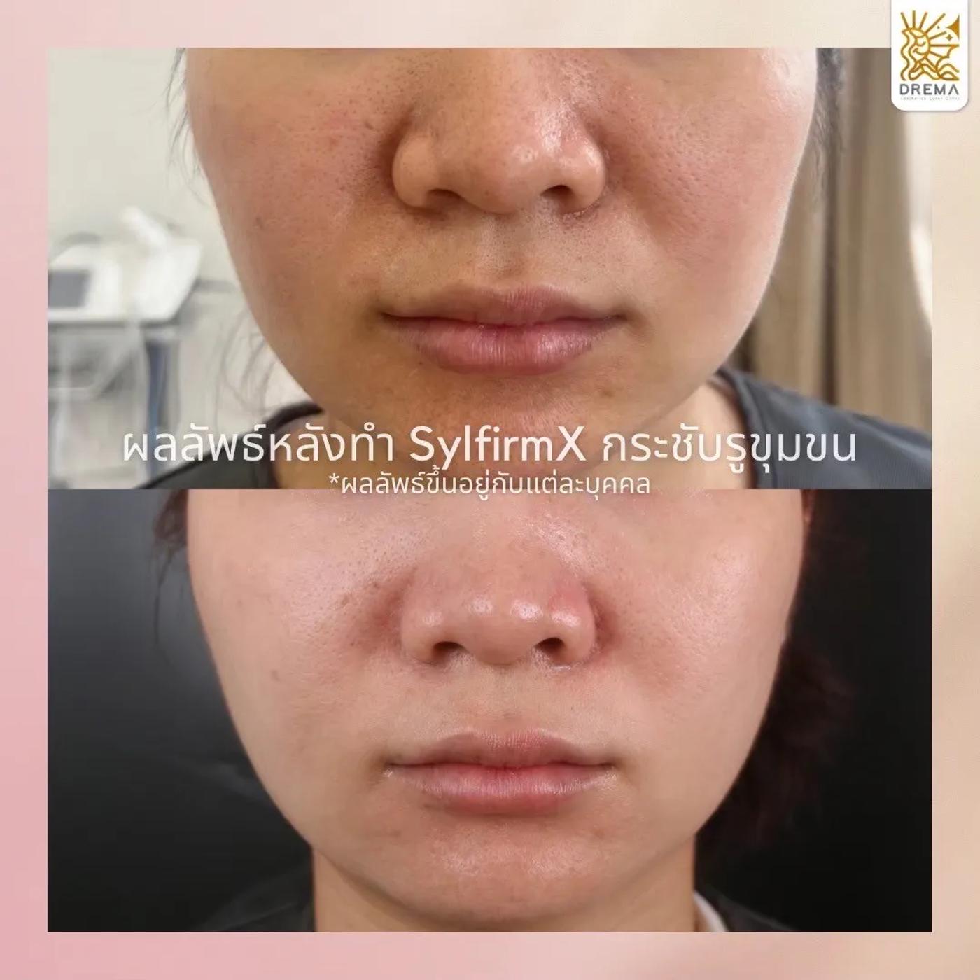 รีวิว SYLFIRM X 18