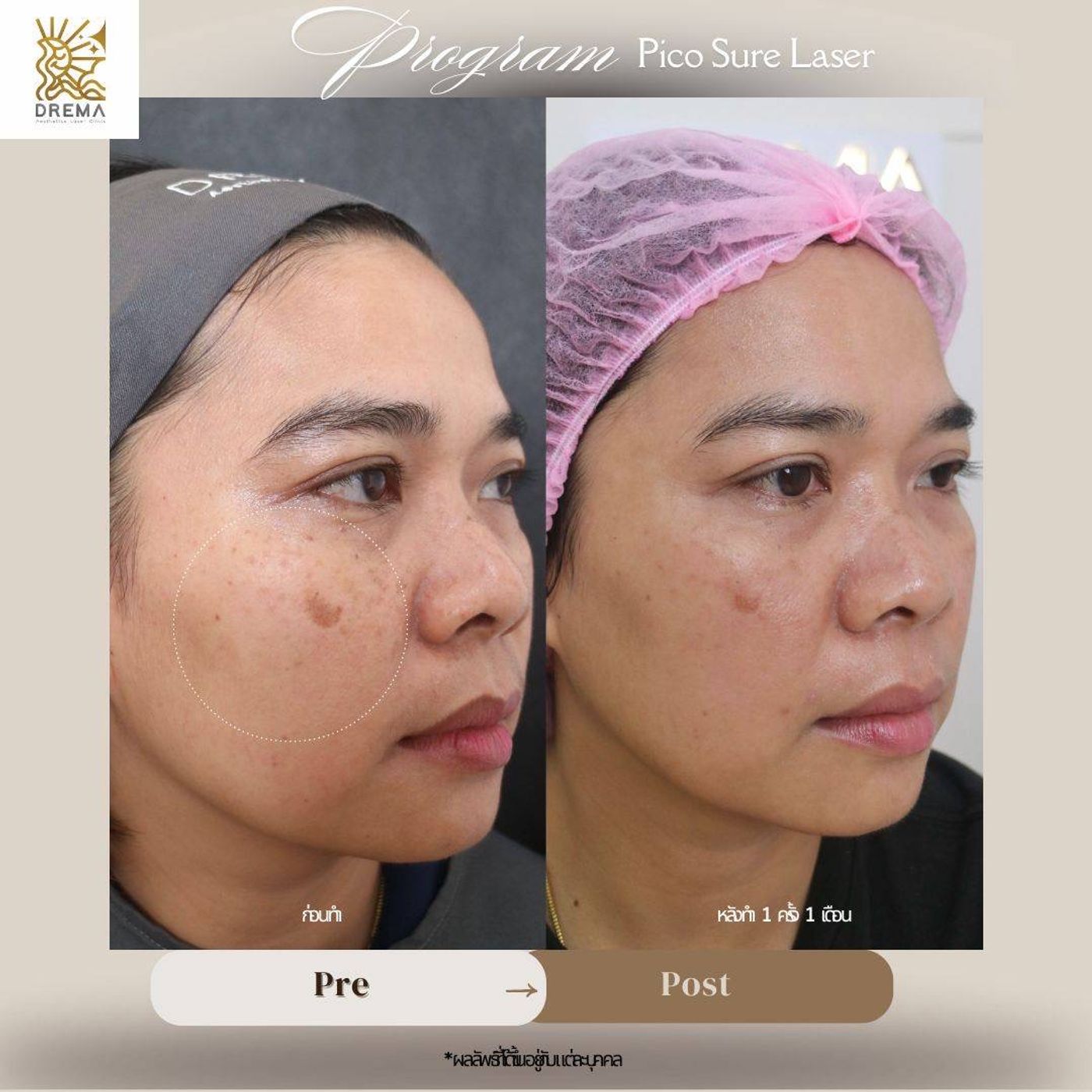 รูปรีวิว Pico Drema Clinic เคสที่ 31