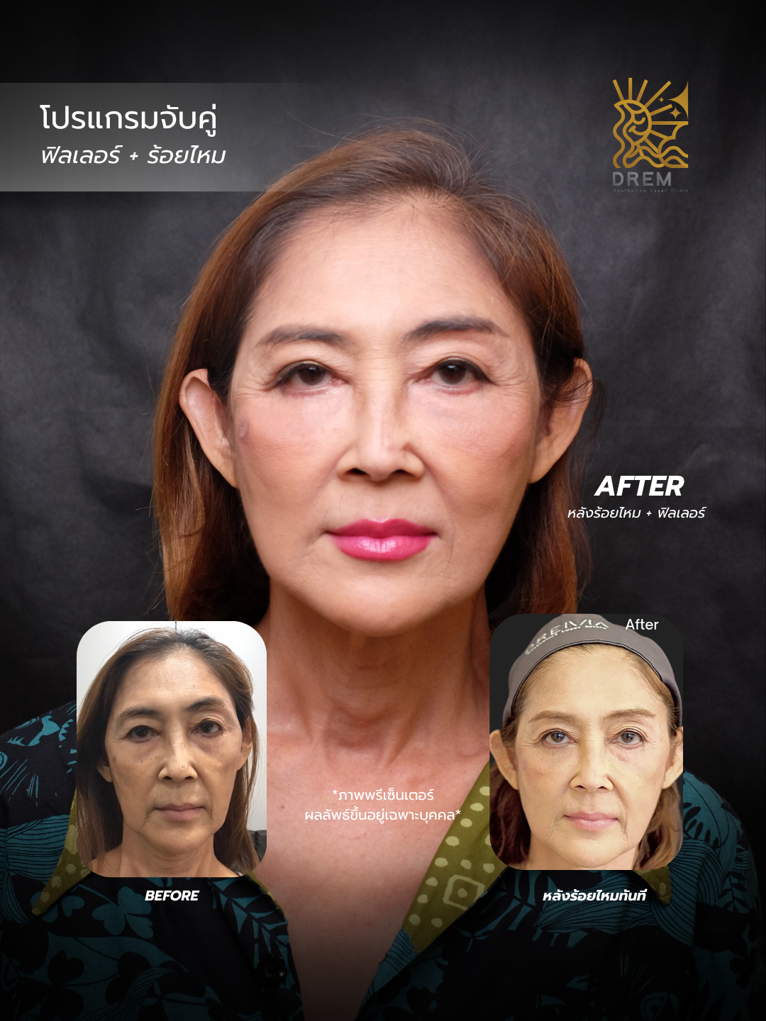 ภาพรีวิวก่อนและหลังทำ