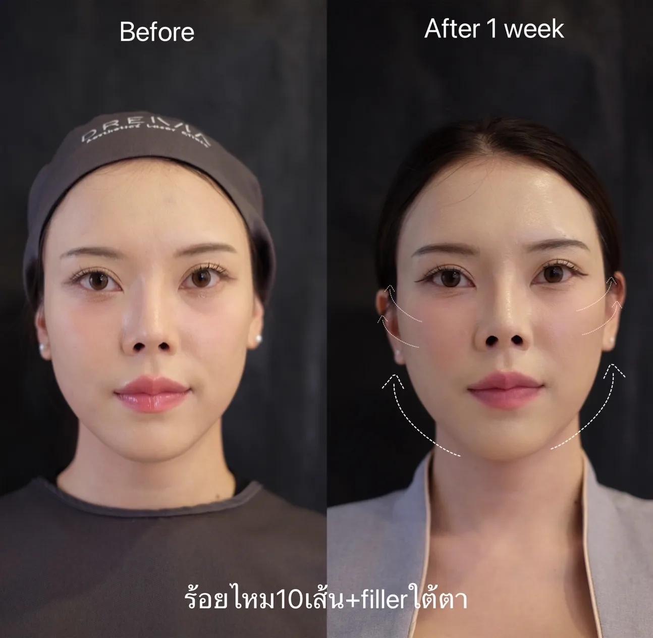 รีวิวฟิลเลอร์ใต้ตา 14
