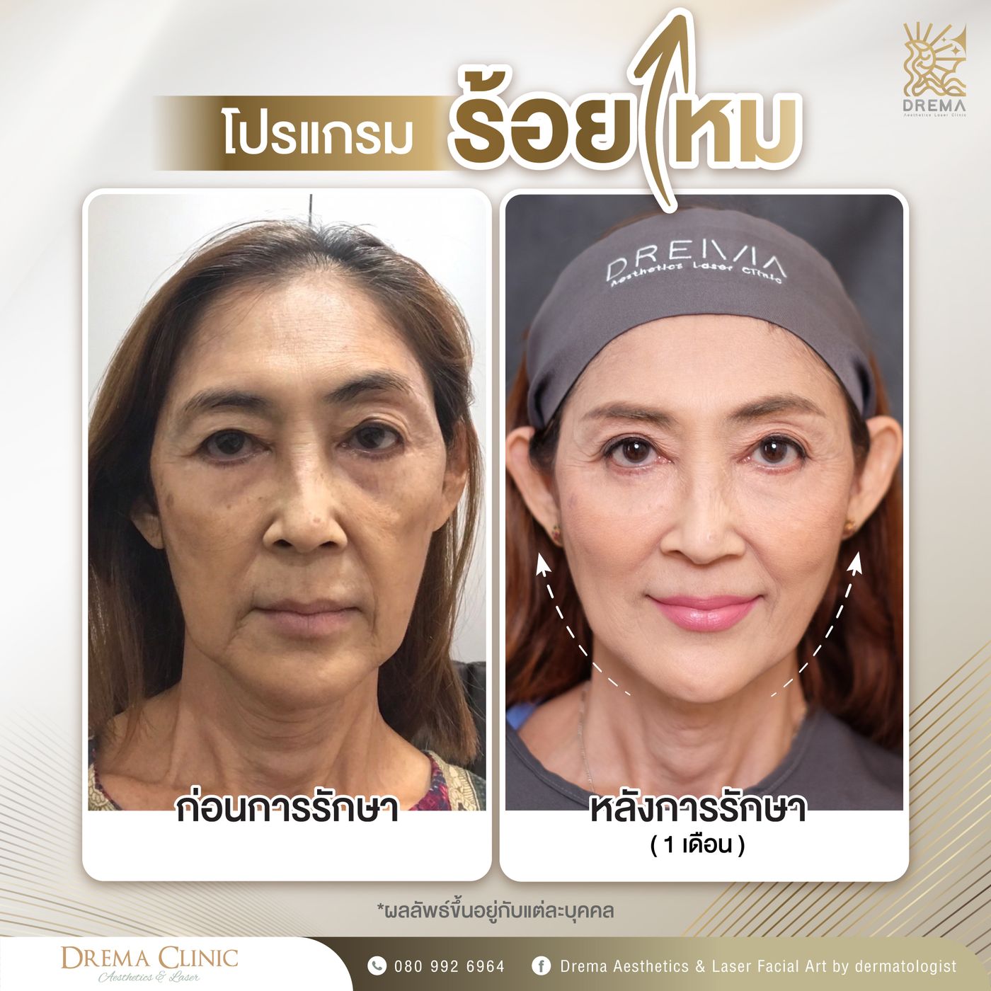 รูปรีวิว ร้อยไหม Drema Clinic เคสที่ 18