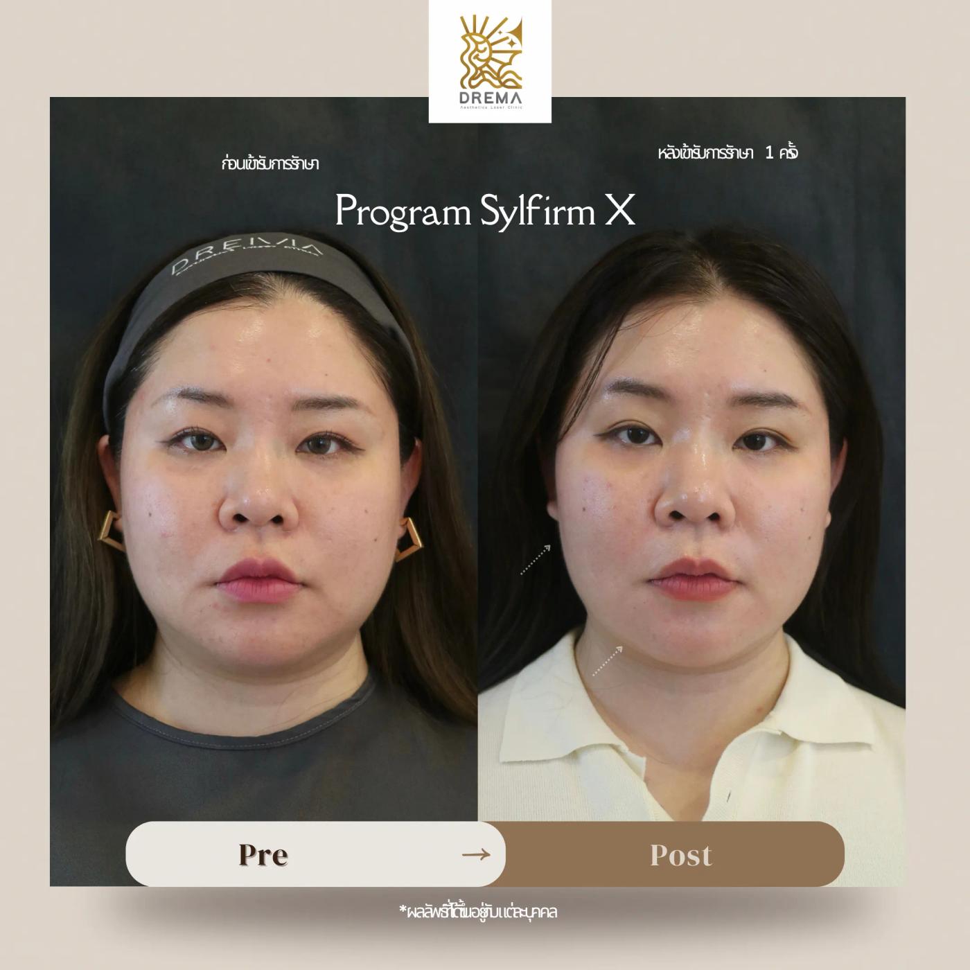 รีวิว SYLFIRM X 9
