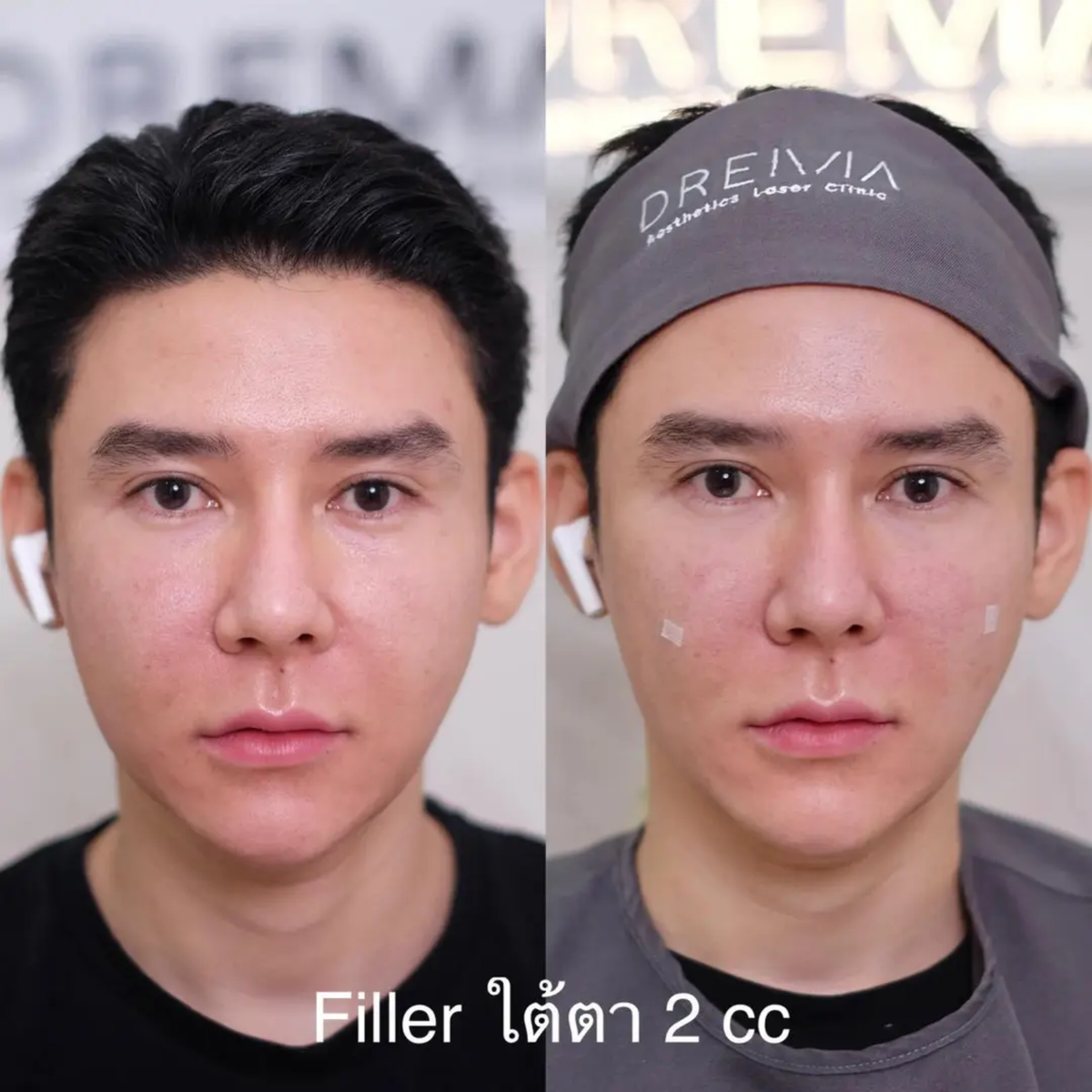 Under-eye filler aftercare guideline - Drema Clinic