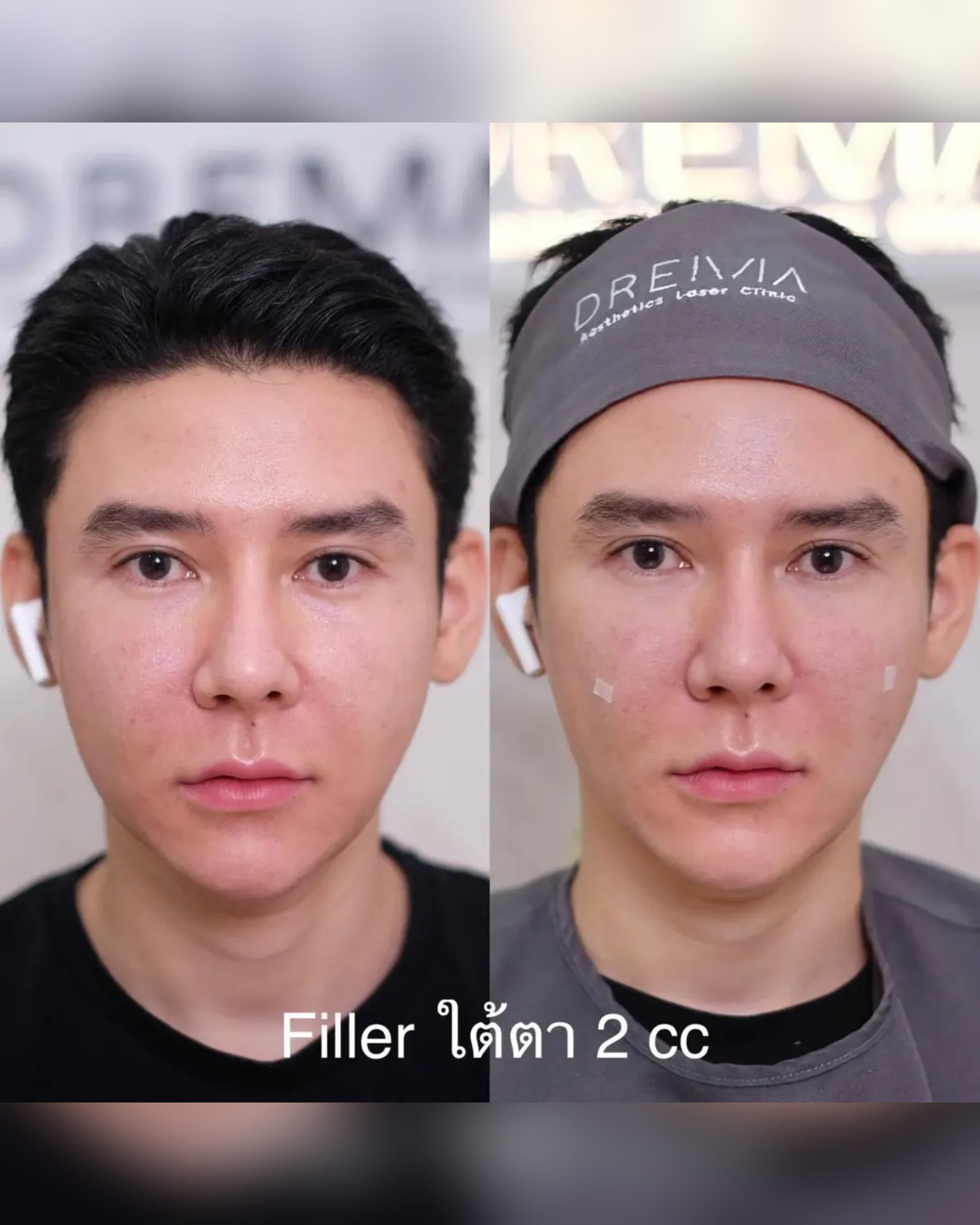 Under-eye filler aftercare guideline - Drema Clinic